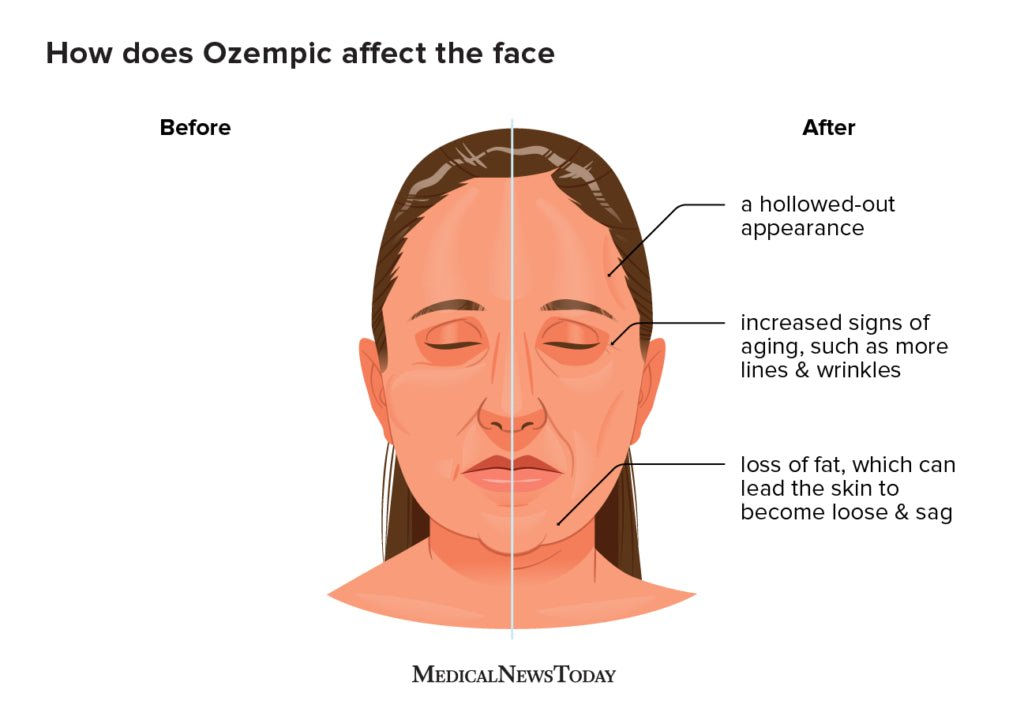 semaglutide facial hollowing side effect What Is 'Ozempic Face' and How To Prevent It Why Do GLP-1s cause Ozempic